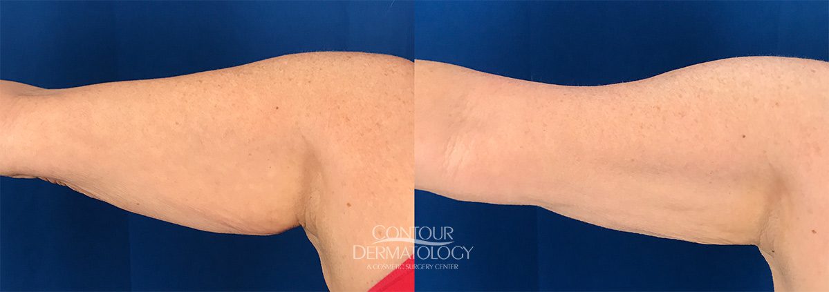 CoolSculpting pour les bras, 2 traitements