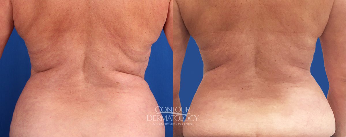 2 traitements CoolSculpting plus 4 traitements VelaShape III