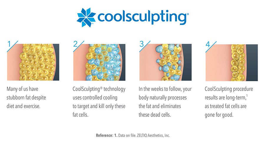 Comment fonctionne CoolSculpting, étape par étape.