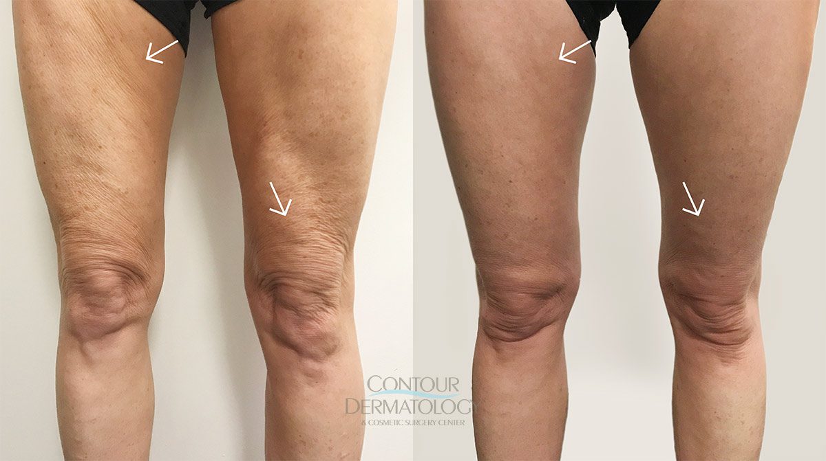 Jambes VelaShape III avant et après