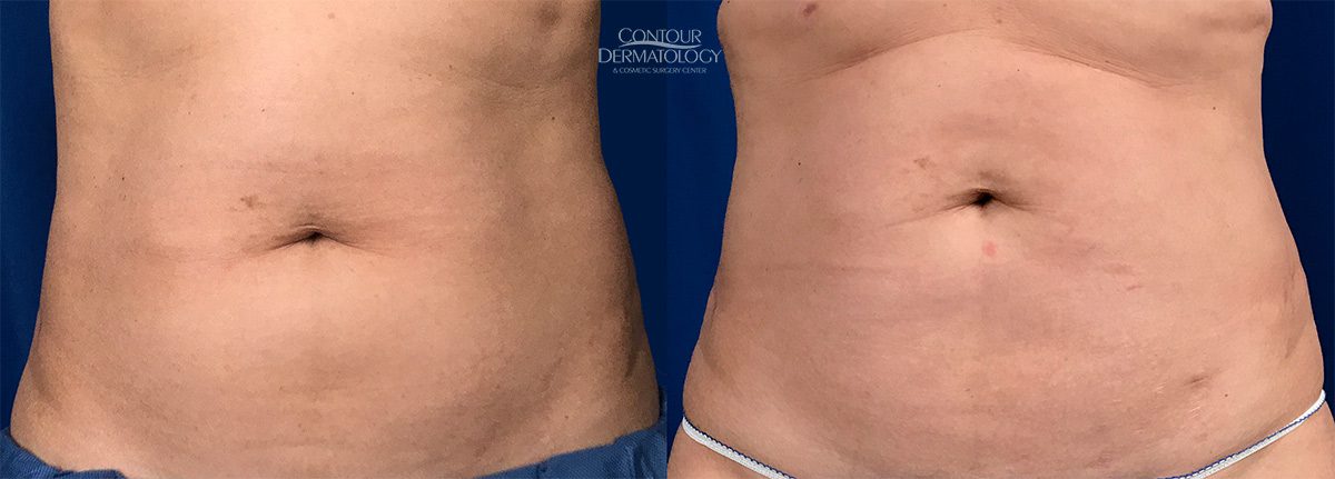 Flancs de liposculpture, 6 mois après, 51 ans